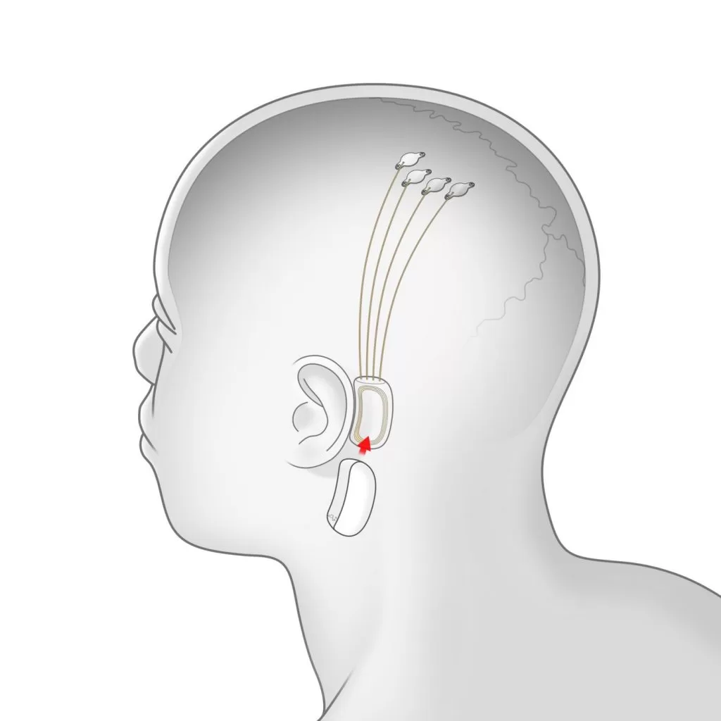 neuralink 2 | neuralink | บอกลาหูฟังแบบเดิม ๆ เมื่อ Elon Musk เตรียมโชว์เทคโนโลยีที่ส่งเสียงเพลงเข้าสู่สมองได้โดยตรง